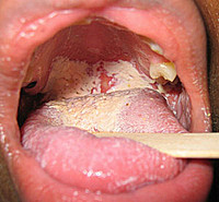 lyme-disease-yeast-infection-oral-thrush